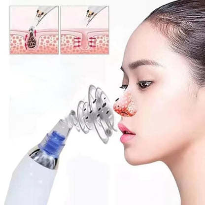 Blackhead Remover Vacuum